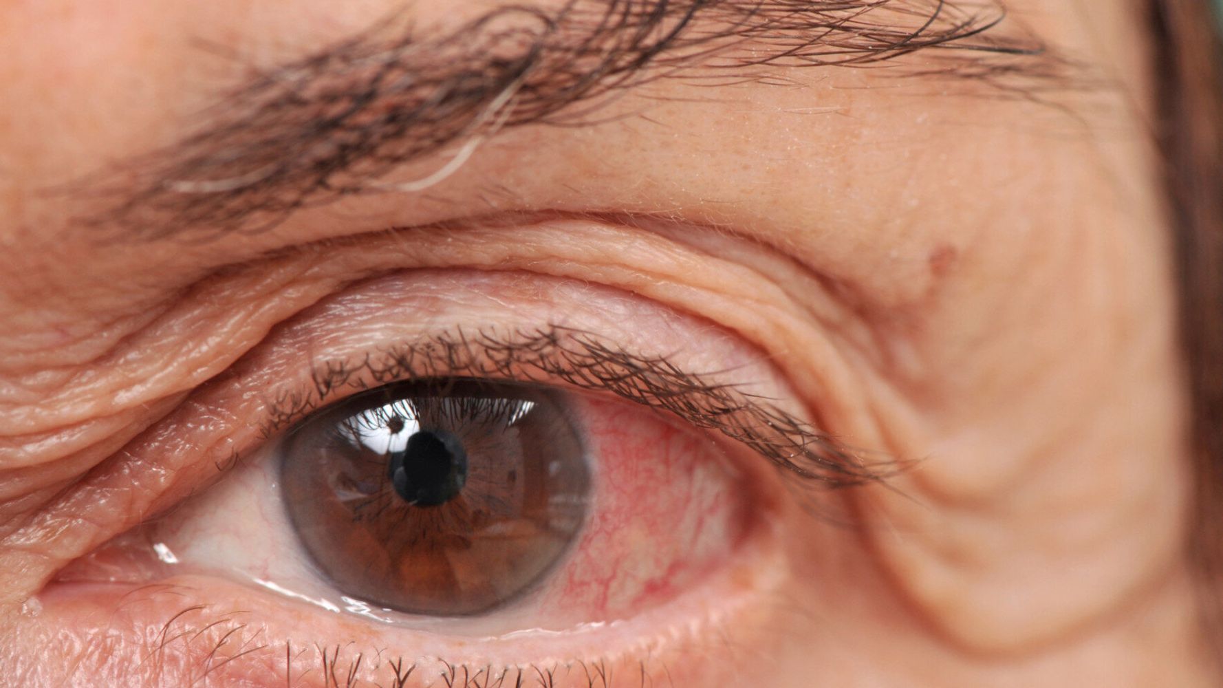 What is Glaucoma? 4