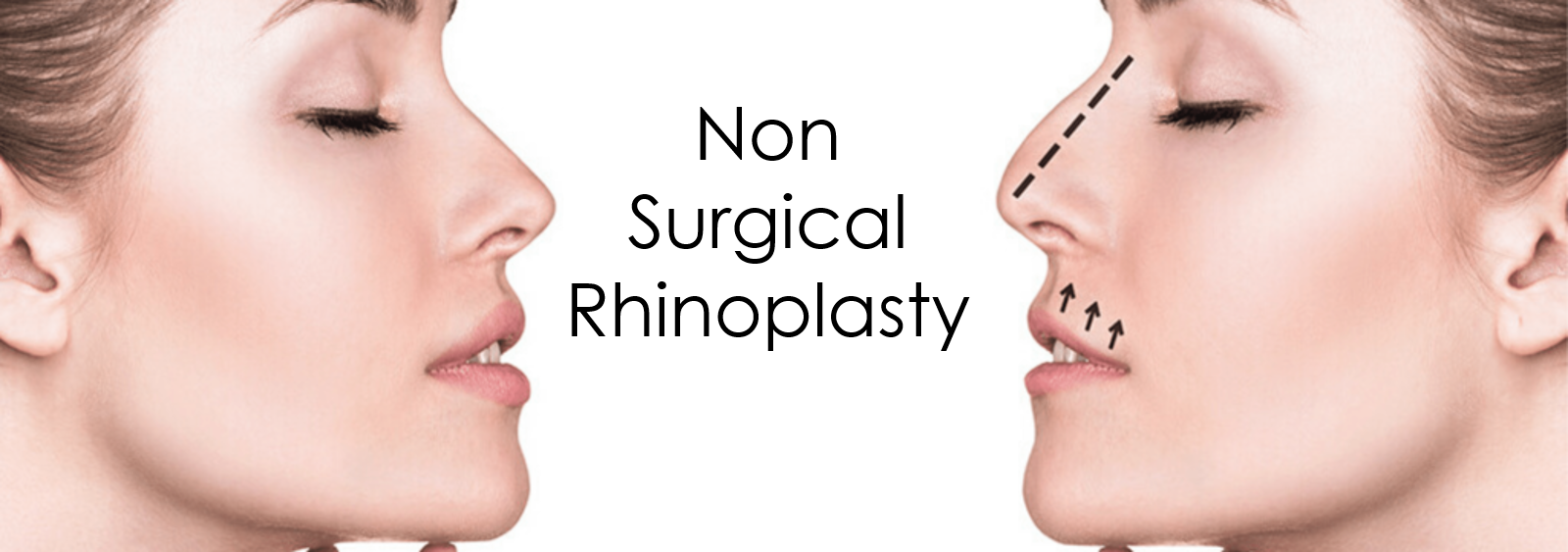 Non Surgical Rhinoplasty
